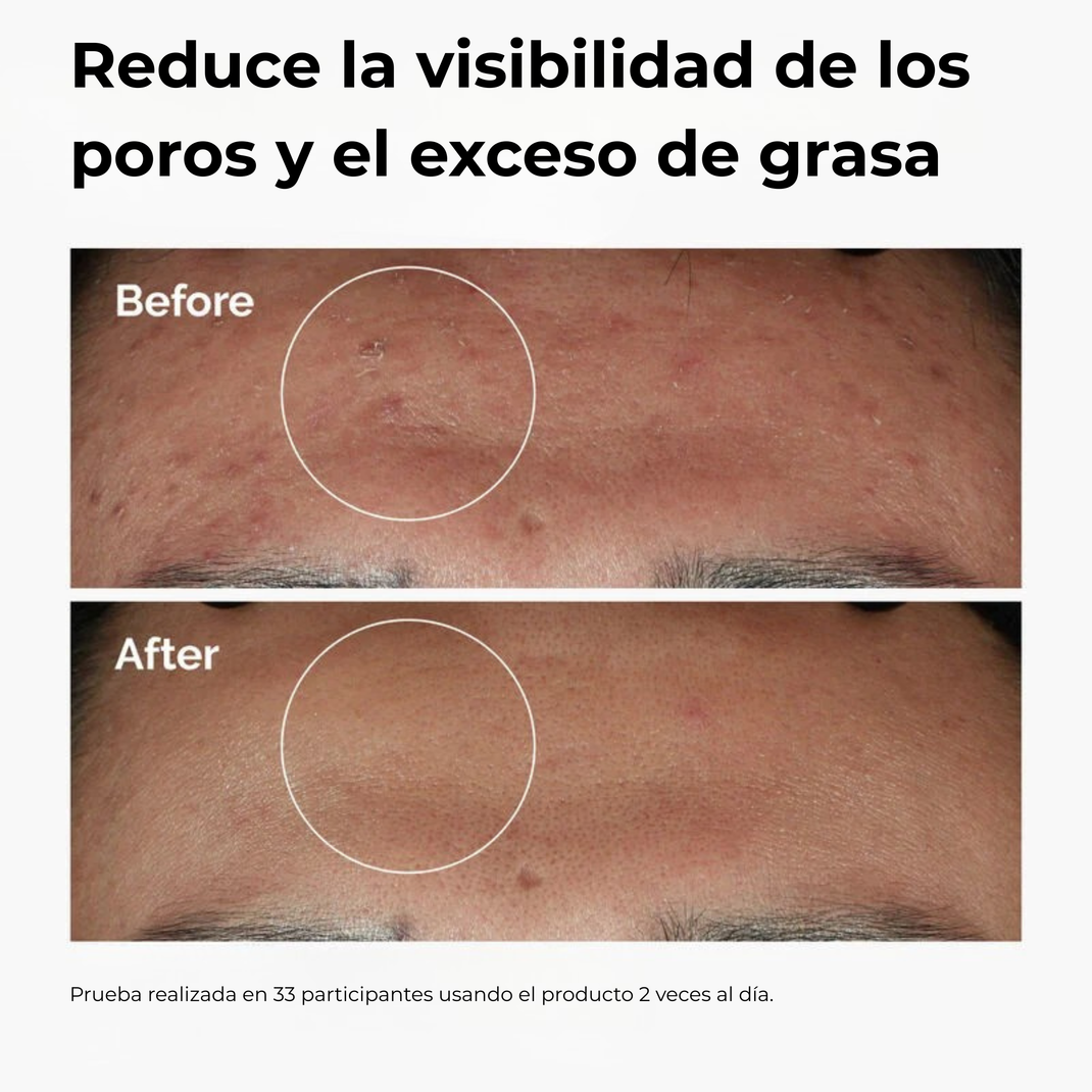 The Ordinary Niacinamide 10% + Zinc 1% | Sérum Vitamina B3 Anti Acné y Control de Grasa