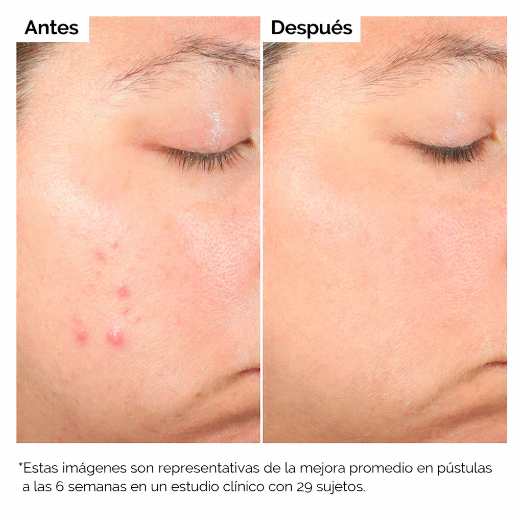 Ordinary Dúo: Niacinamida + Ácido Salicílico