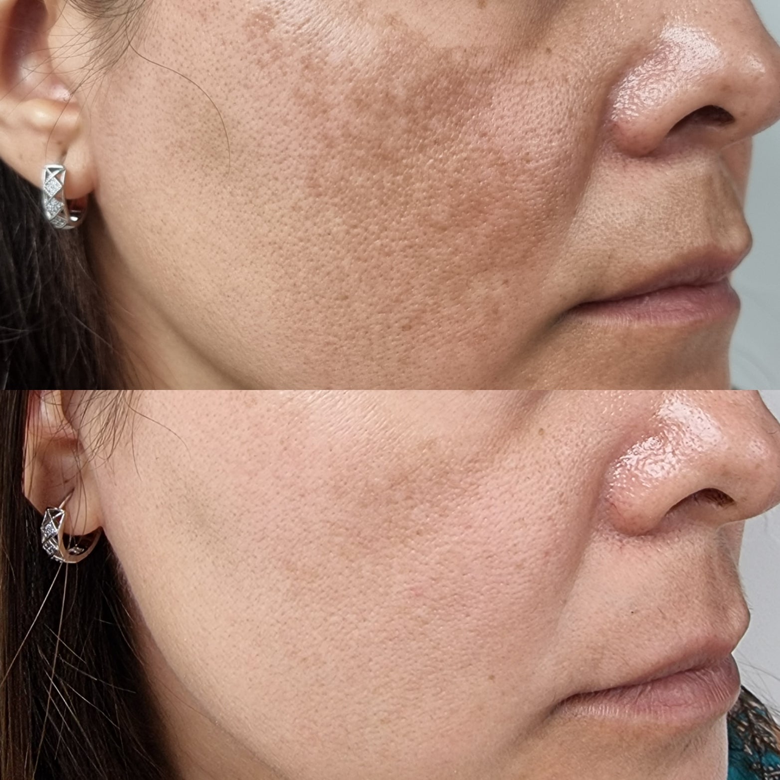 The Ordinary Ácido glicólico al 7% Tónico exfoliante para una Piel Radiante