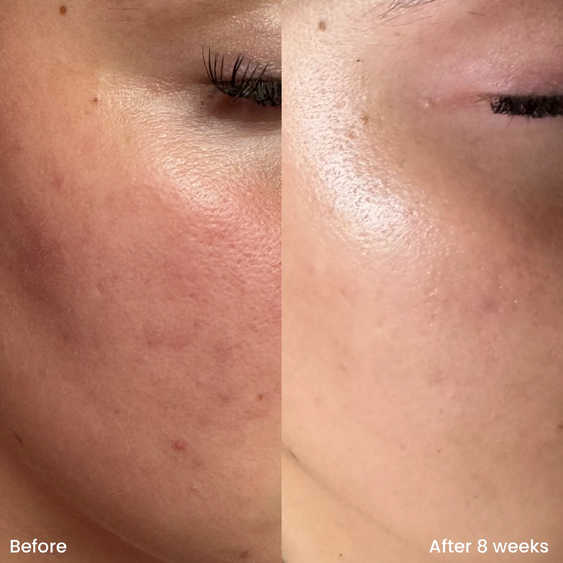 The Ordinary Niacinamide 10% + Zinc 1% | Sérum Vitamina B3 Anti Acné y Control de Grasa
