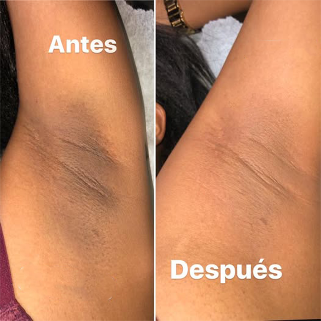 The Ordinary Ácido glicólico al 7% Tónico exfoliante para una Piel Radiante