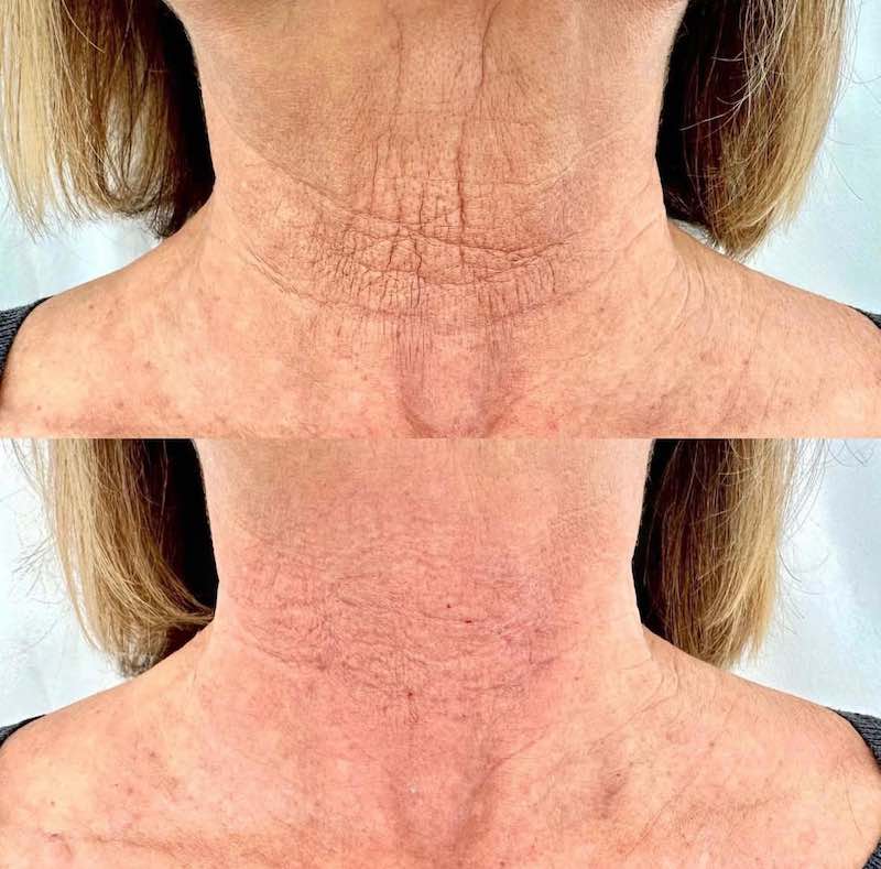 Crema GOPURE reafirmante para el cuello que reduce arrugas y combate los signos del envejecimiento