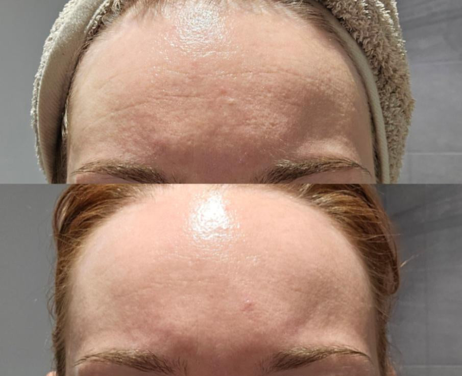 Dúo Ordinary: Retinol + Ácido Hialurónico para una piel renovada