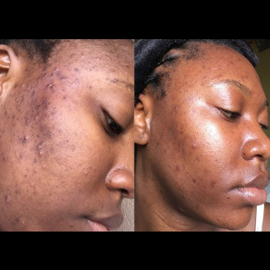 The Ordinary Niacinamide 10% + Zinc 1% | Sérum Vitamina B3 Anti Acné y Control de Grasa