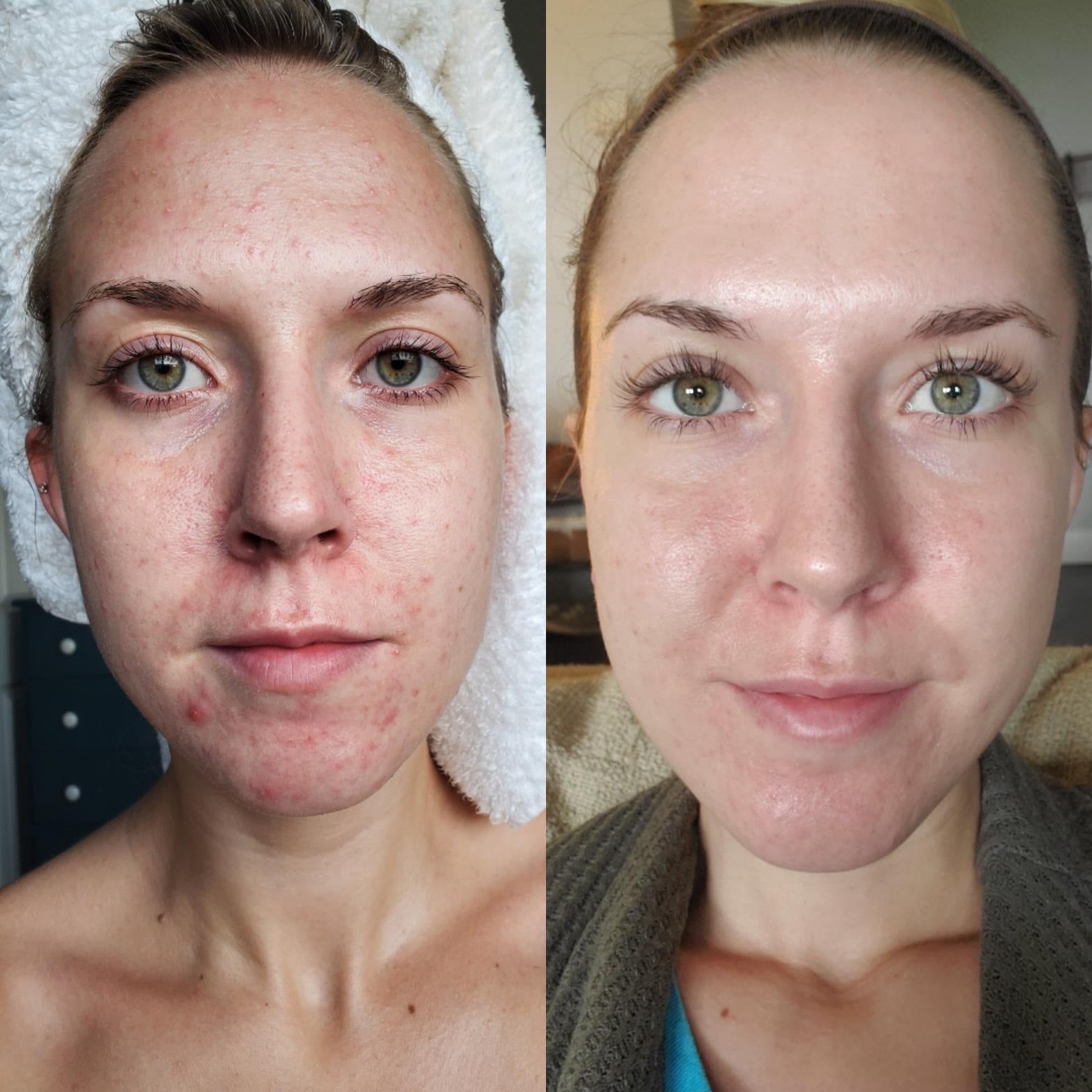 Ordinary Dúo: Niacinamida + Ácido Salicílico