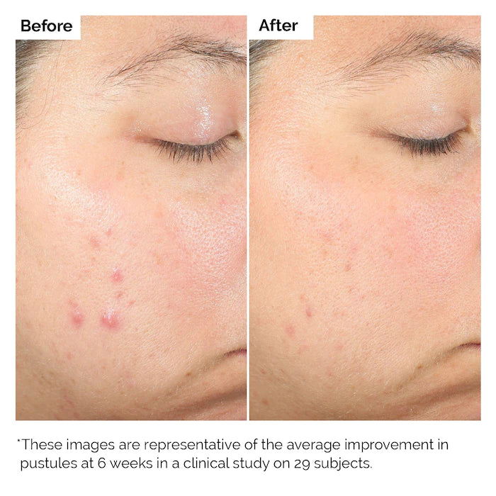 The Ordinary ácido Salicílico Salicylic Acid 2% Solution